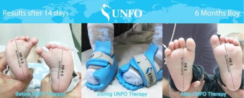 Ortesi neonato metatarso varo